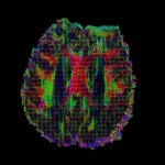 An axial slice of a diffusion tensor imaging data, each pixel is represented with an ellipsoid glyph depicting water molecule diffusion.  Alternate: HARDI (high-angular resolution diffusion imaging), Axial view.The tensor can be visualized as an ellipsoid in 3D space, showing fluid mappings and brain connectivity. Image by David Shattuck, PhD. and Paul M. Thompson, PhD