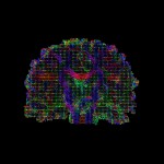 A coronal slice of a diffusion tensor imaging data, each pixel is represented with an ellipsoid glyph depicting water molecule diffusion. Alternate: HARDI (high-angular resolution diffusion imaging), Coronal view. The tensor can be visualized as an ellipsoid in 3D space, showing fluid mappings and brain connectivity. Image by David Shattuck, PhD. and Paul M. Thompson, PhD.