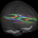 An axial slice of a diffusion tensor imaging dataset set inside a brain surface.  The coloring indicates the principal diffusion direction, with red going left-right, green going anterior posterior, and blue going inferior-superior.  Alternate: The primary eigenvector of the diffusion tensor in these two axial slices indicates the fiber orientation at each voxel. A transparent brain surface rendering provides a sense of position and scale. Software: DIRAC. Image by Vishal Patel, PhD.