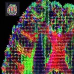 HARDI (high angular resolution diffusion imaging) tracks show aligned brain DTI data across subjects with a 3D fluid transformation, optimizing a measure based on information theory. Image by David Shattuck, PhD. and Paul M. Thompson, PhD.