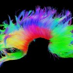 White matter fiber architecture from the Connectome Scanner dataset. Shown are commissural connections.  The fibers are color-coded by direction: red = left-right, green = anterior-posterior, blue = ascending-descending (RGB=XYZ). www.humanconnectomeproject.org